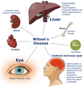 出生缺陷科普系列||肝豆状核变性
